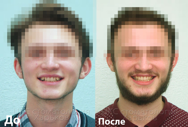 Улыбка до и после ортодонтического лечения