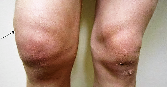 Natural Way Of Curing Arthritis Natural Way Of Curing Arthritis