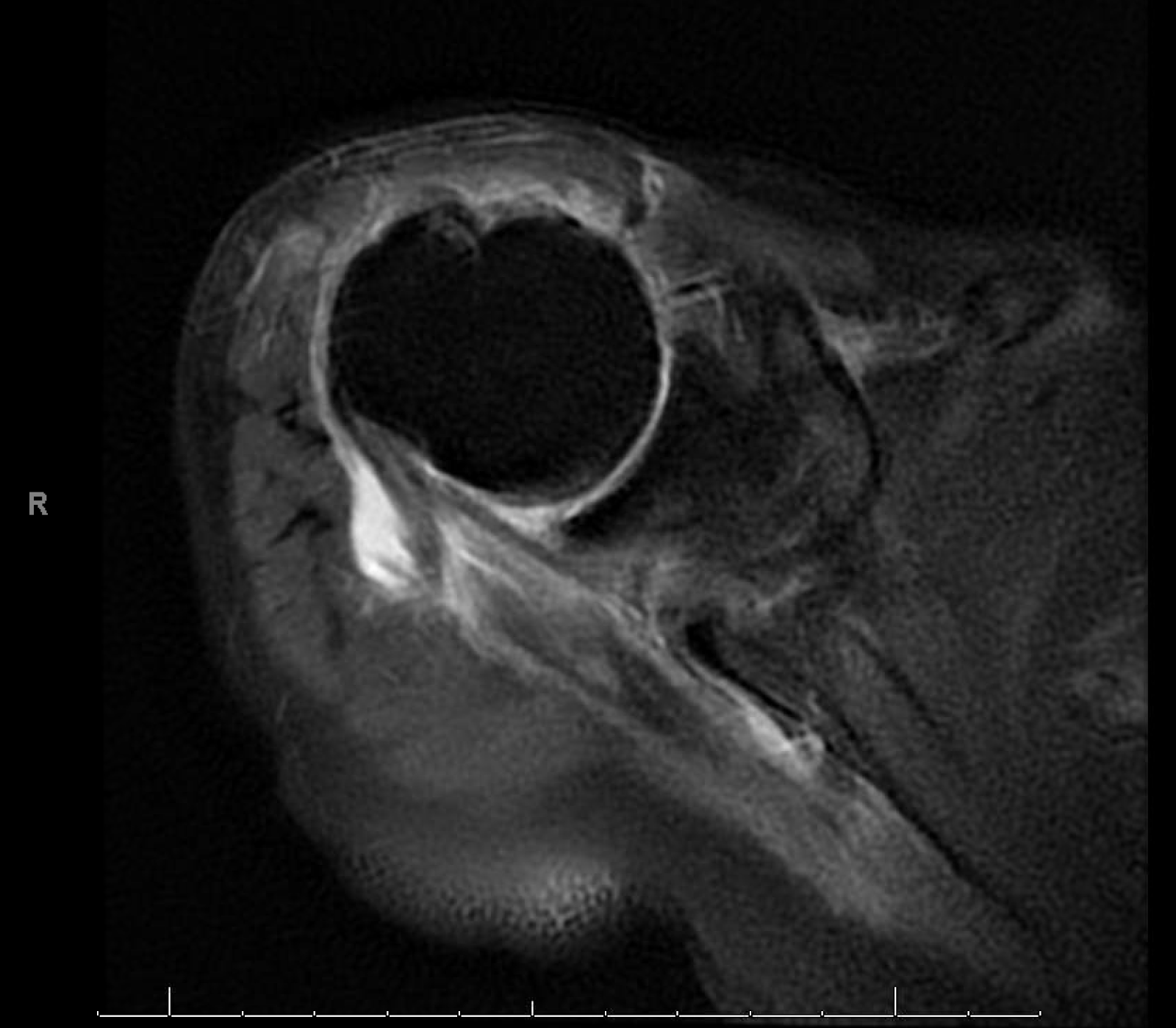 Shoulder and Elbow Surgery Reverse total shoulder arthroplasty for