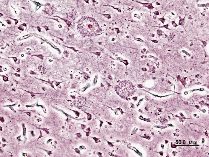 Alzheimer's Disease amyloid plaques and neuro-fibrillay tangles in brain tissue