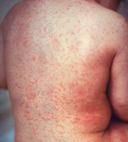 measles Picture Image on MedicineNet.com