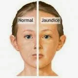 jaundiced baby high bilirubin 2 3 4 5 6 7 8 9 days birth