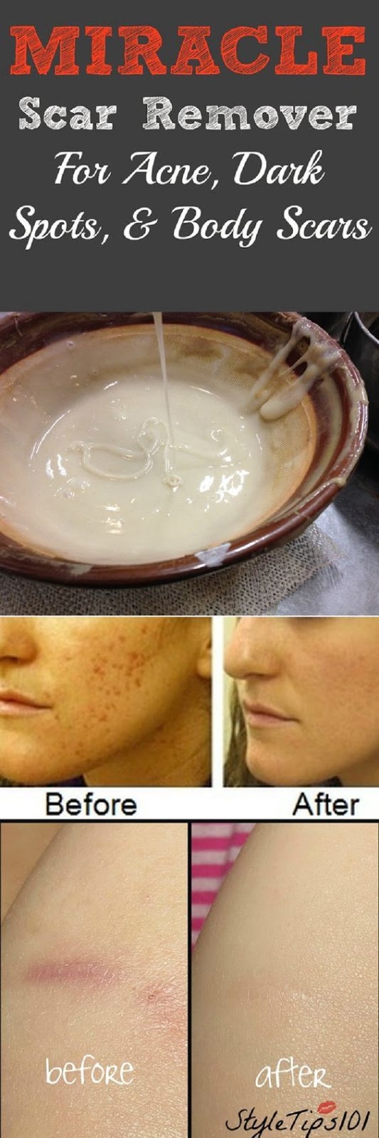MIRACLE HOMEMADE SCAR REMOVER FOR ACNE AND DARK SPOTS Health Pins