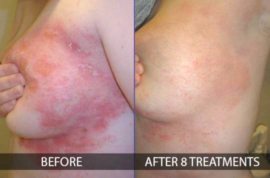 Psoriasis Before And After Treatment