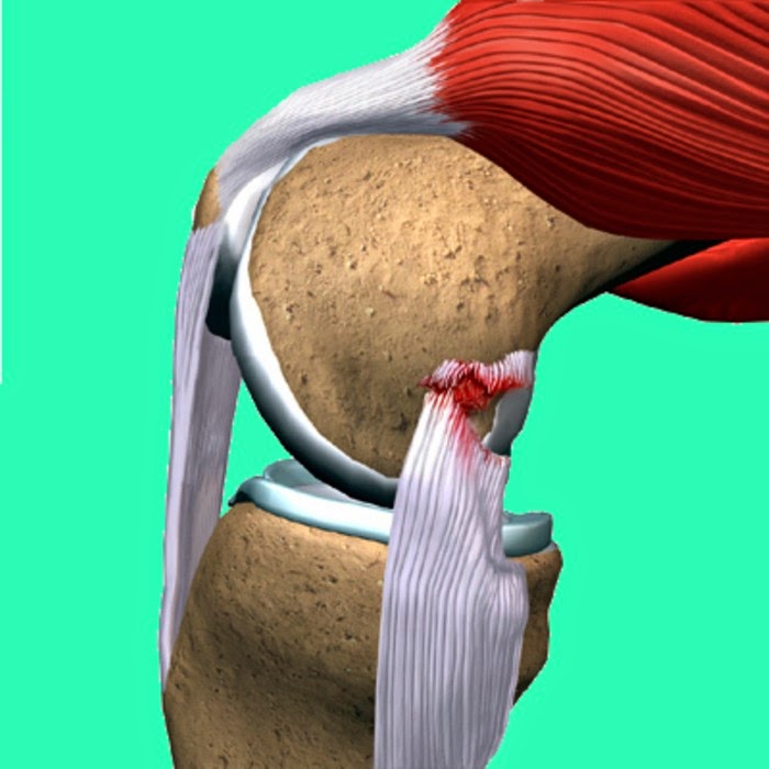 Лечение частичного разрыва мышц. Частичный разрыв коллатеральной связки. Разрыв сухожилия бедра. Мышцы тазобедренного сустава.