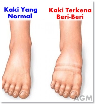 cara menyembuhkan beri-beri