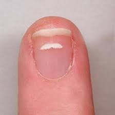 Descubre el motivo por el que aparecen las manchas blancas en las uñas