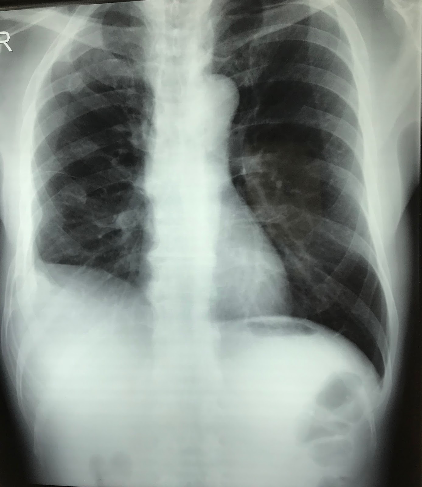 Spleen Cancer Xray CancerWalls