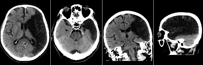 Radiology MRI: MCA Territory