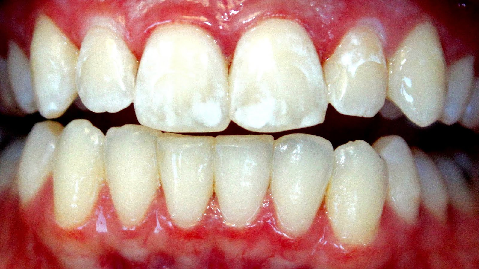 What Are White Marks On Teeth White Choices