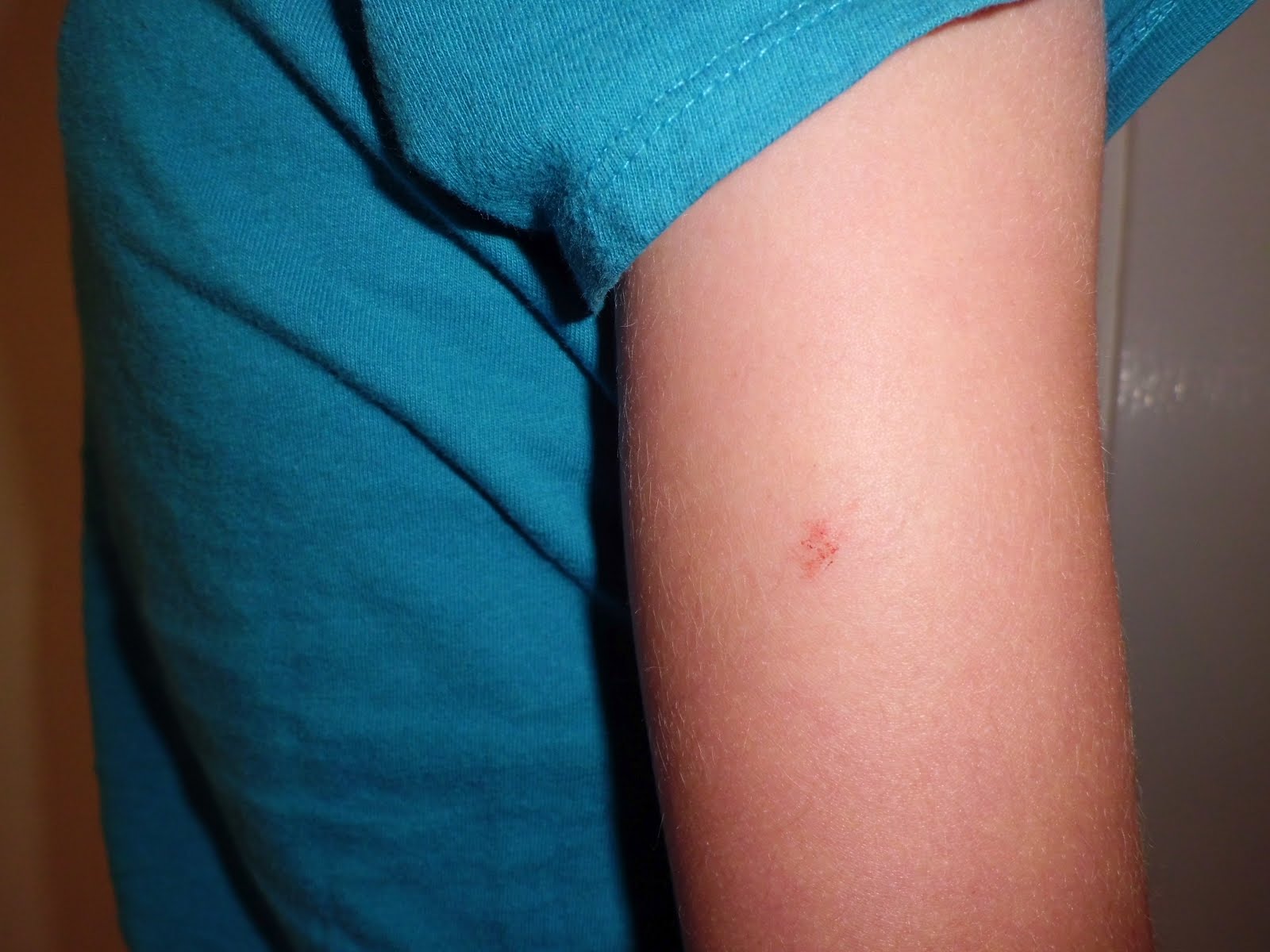 Reactions to allergy shots
