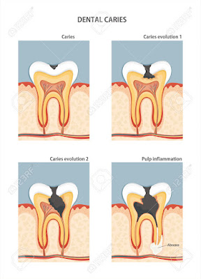 Development of dental caries illustration Stock Vector
