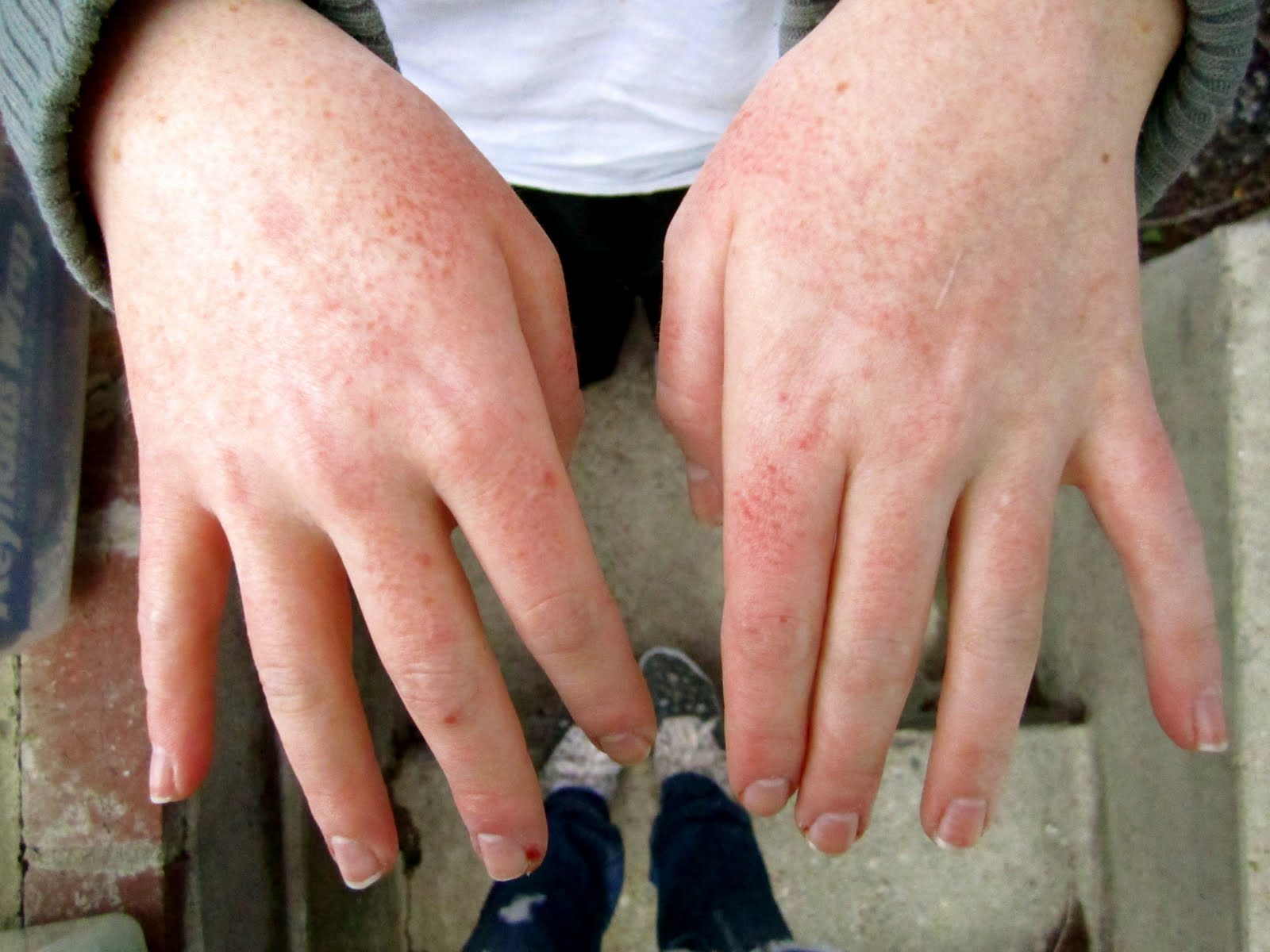 What is Contact Dermatitis? Chemical Skin Rash – Health Talk