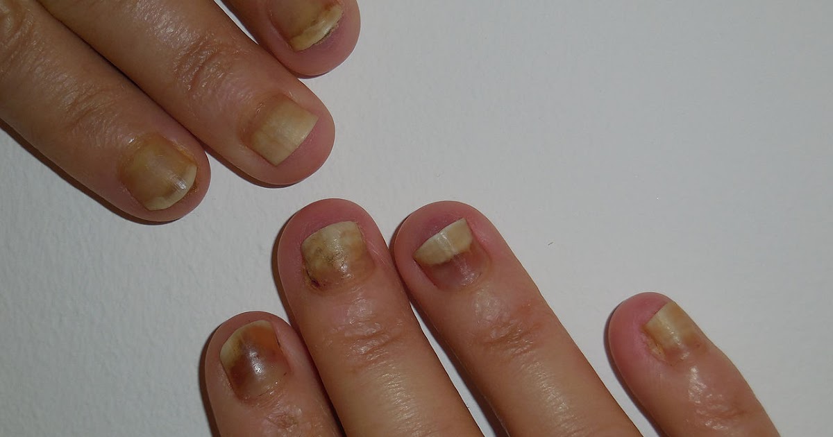 EFFECTS FROM NAIL POLISH.