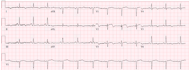 serial ecgs serial ecgs