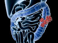 Photo showing colon cancer