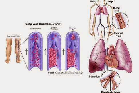 搶救靜脈栓塞　物理性血栓抽吸術療效佳