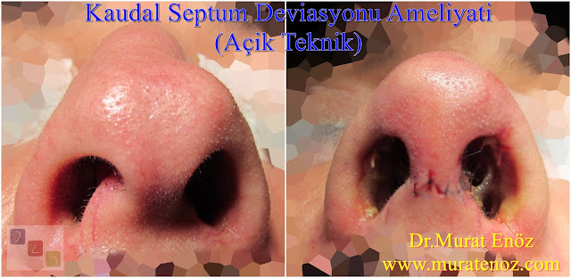 Treatment of caudal septum deviation - Open technique caudal septoplasty operation
