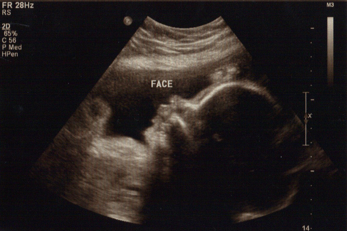 Малыш на 32 неделе. 30 Недель беременности УЗИ плода. Фото плода в 30 недель беременности на УЗИ. УЗИ ребенка 30 недель беременности. 32 Недели беременности фото плода на УЗИ.