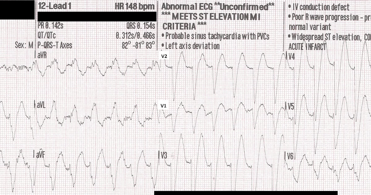 Dr. Smith's ECG Blog Sudden Chest pain and SOB with a Wide Complex