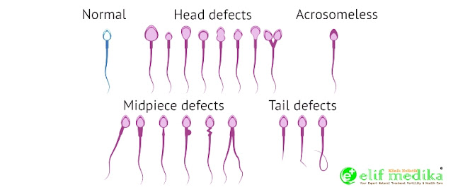 Bentuk sperma normal dan abnormal atau cacat Bentuk sperma normal dan abnormal atau cacat