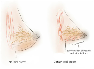 breast augmentation Korea