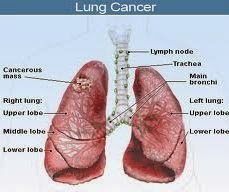 obat kanker Paru alami stadium 3, alternatif kanker Paru stadium 3, obat alami tumor Paru