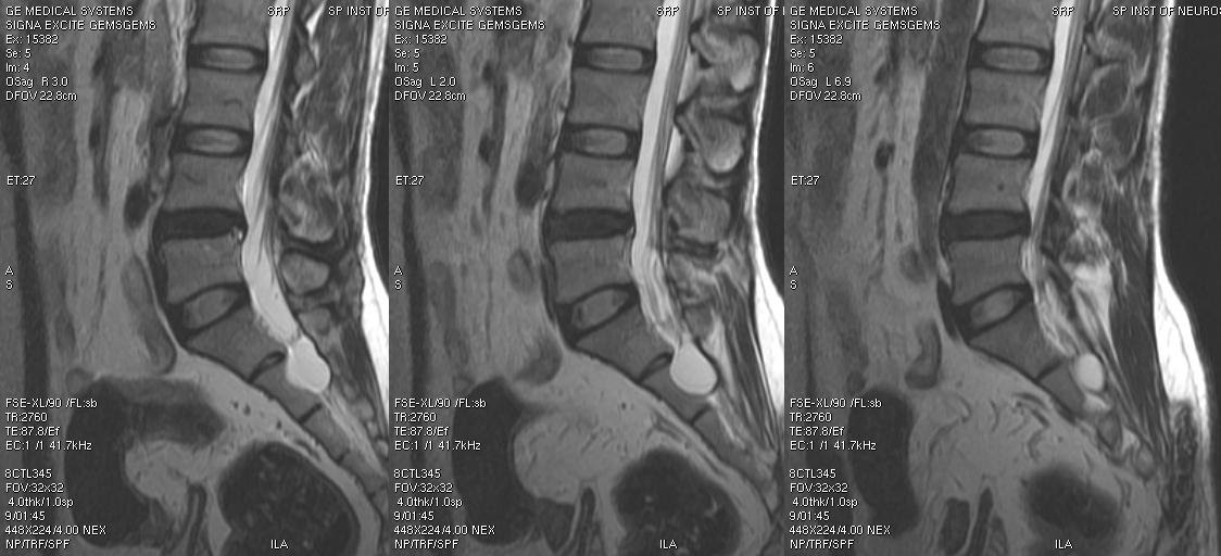 Neuroradiology Cases: Tarlov cyst MRI