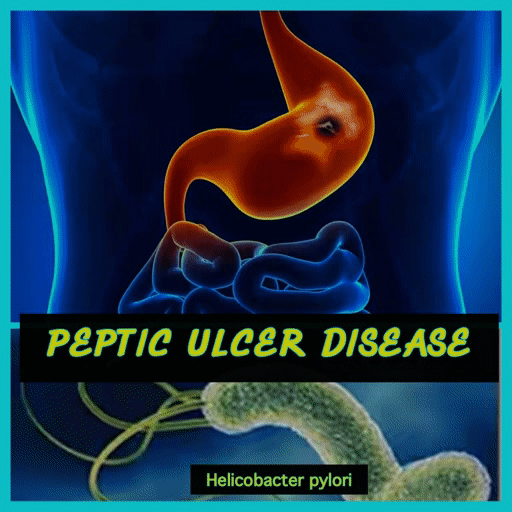HEALTH INFO SHARE VIDONDA VYA TUMBO (PEPTIC ULCER DISEASE)