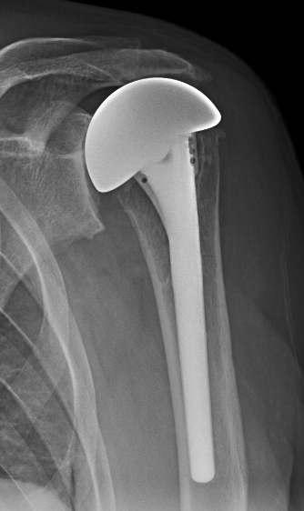 Shoulder Arthritis/Joint Replacement Rotator cuff tears: Is ...