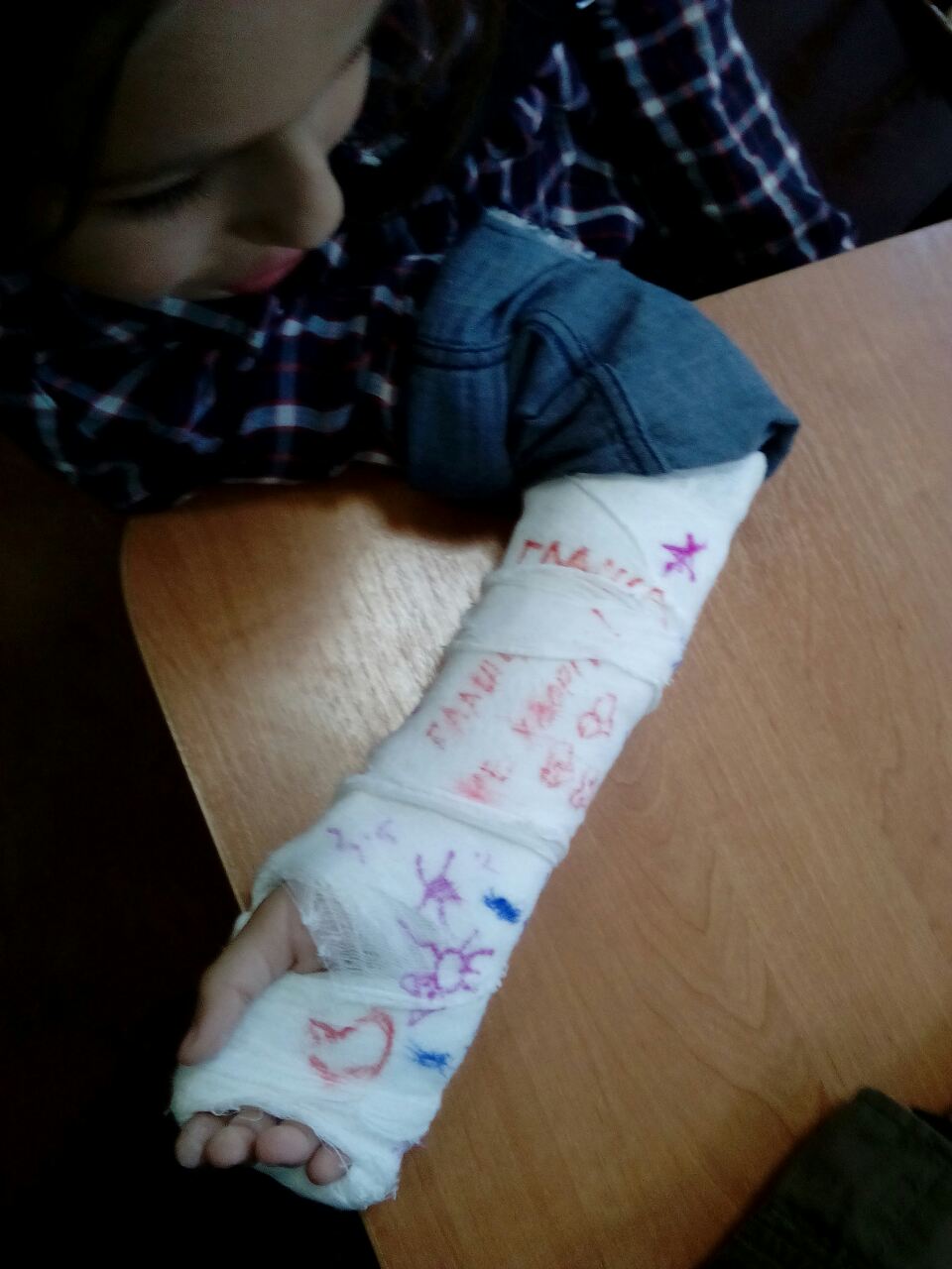 девочка с переломом ноги в больнице. перелом обеих рук. перелом обеих рук. перелом обеих рук. девушка сломала обе руки.