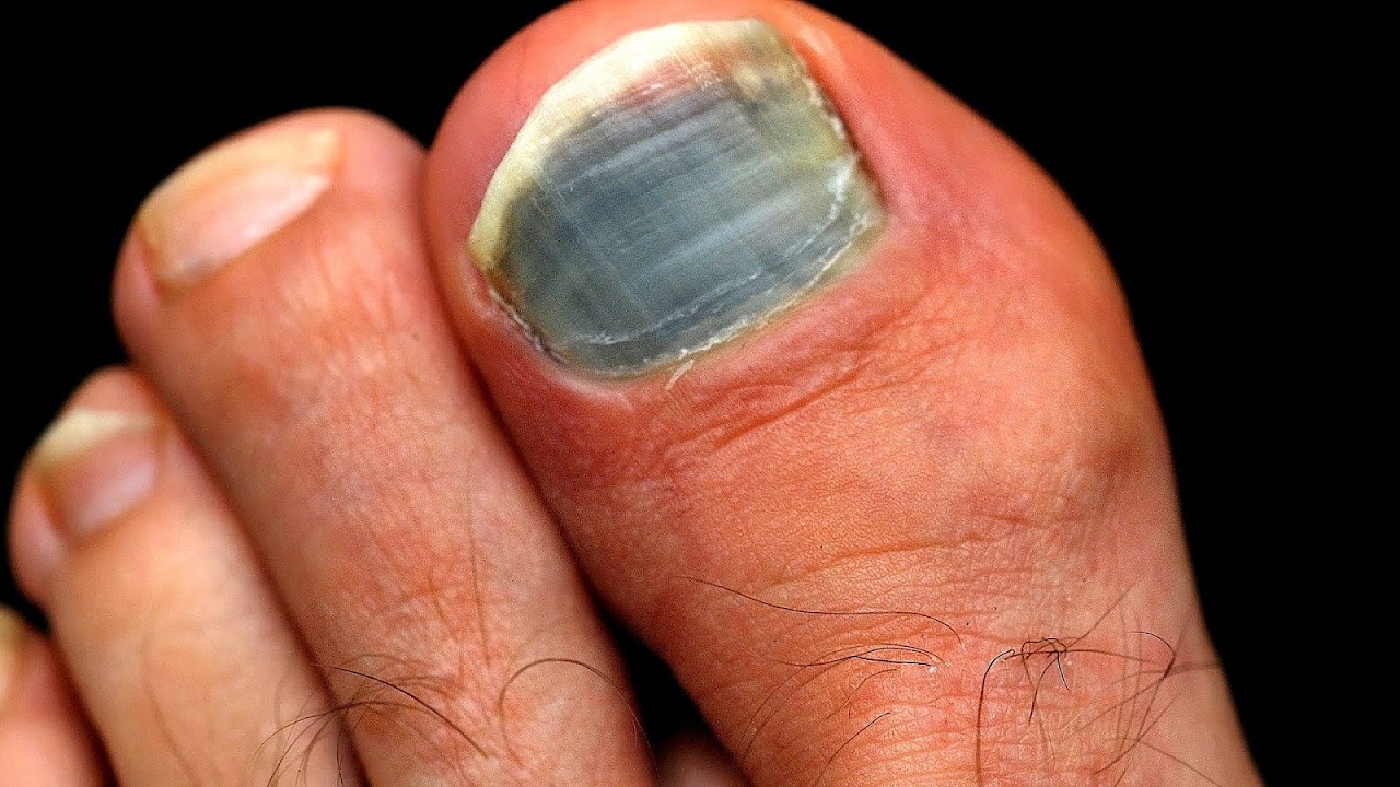 Subungual hematoma Toenail Injury Injury Choices