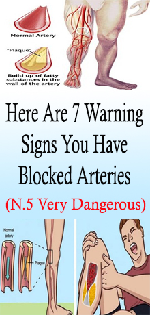 Here Are 7 Warning Signs You Have Blocked Arteries - Nutrition Health Tips
