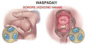 Berapa Harga Obat Kencing Nanah Gangjie Ghosiah Di Banjar Martapura