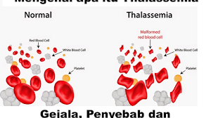 Mengenal apa itu Thalassemia, Gejala,Penyebab dan Cara mengobatinya.