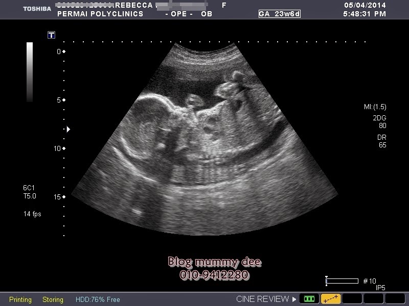 Blog Mummy Dee Scan 3D/4D di Kota Kinabalu, Sabah