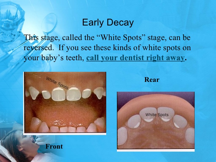 Pediatric Dentist, Bangalore Process of Dental Caries in