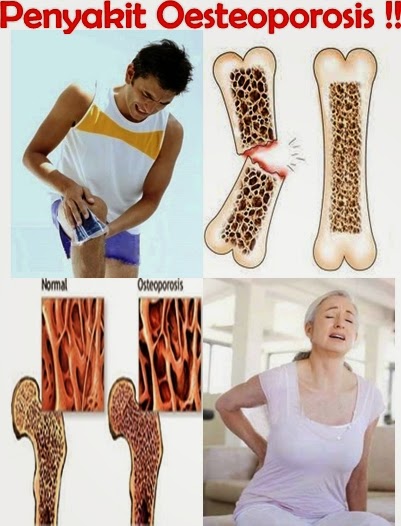 Pengobatan Terbaik Untuk Osteoporosis