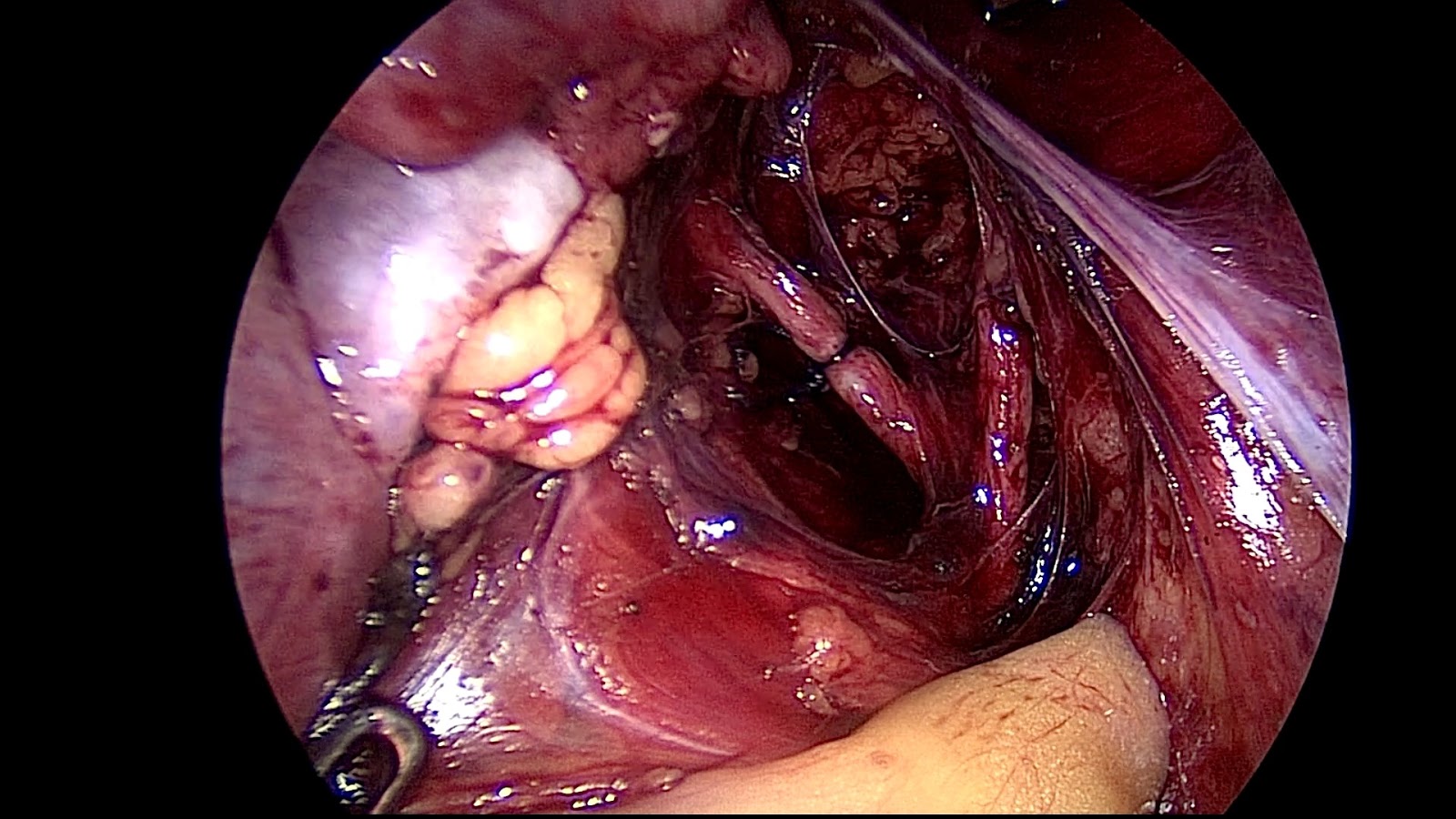 Journal of Postgraduate Gynecology & Obstetrics: Scar Ectopic Pregnancy