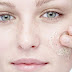 Does Exfoliating Help Acne Prone Skin ?