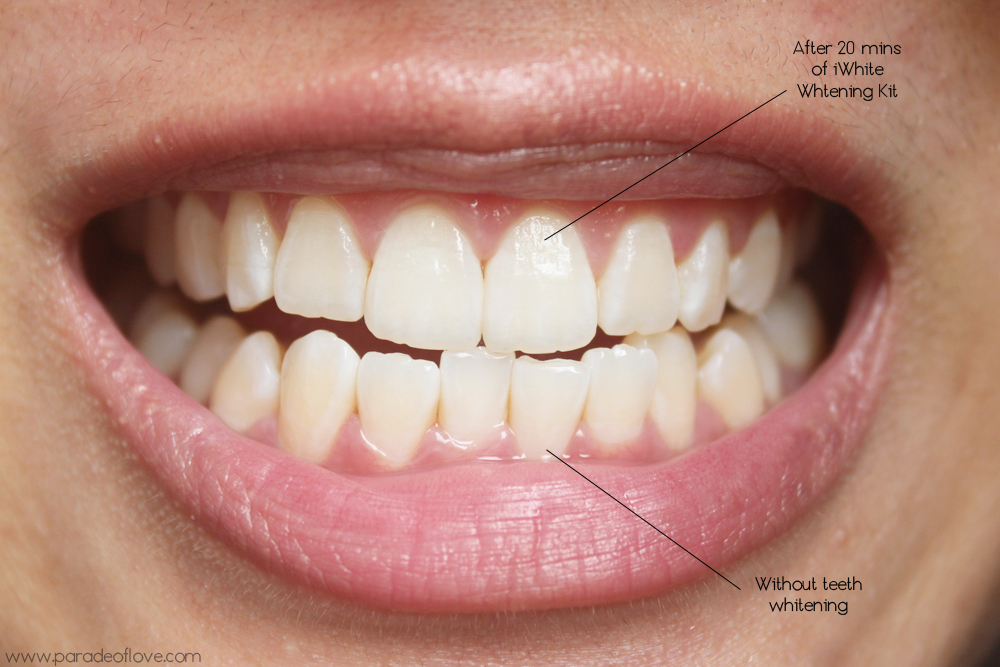 klem medaillewinnaar Vochtig iWhite Instant Teeth Whitening Review : Roanna Tan | Paradeoflove