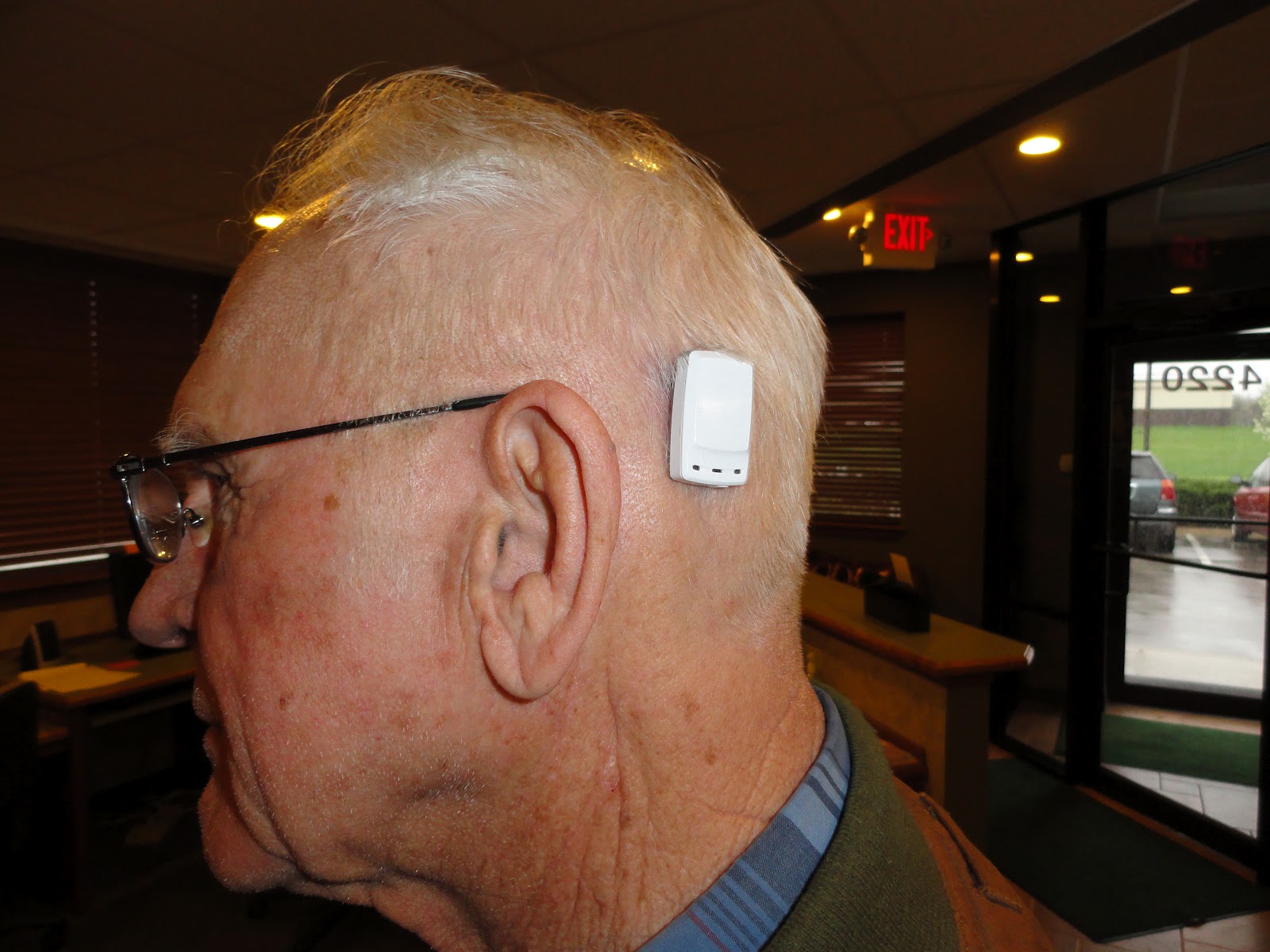 Oxford Impressions Cochlear Baha 3 Implant