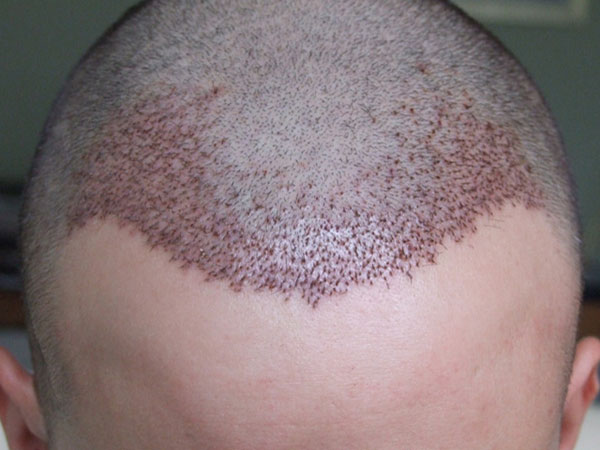 Fuehairtransplantindubaicost Fue Hair Transplant The Good The