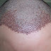 FUE Hair Transplant: The Good, the Bad, and the Ugly