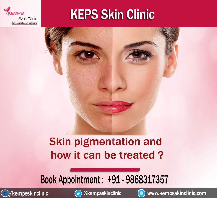 What is Skin pigmentation and how it can be treated KEMPS Skin Clinic