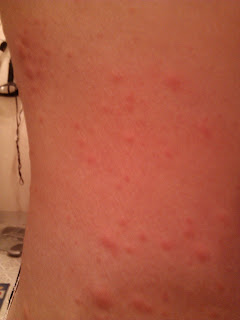 Skin rash from bactrim ds
