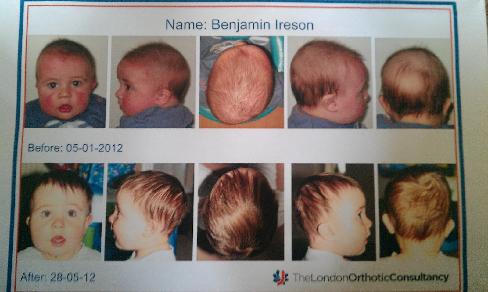 Bens Plagiocephaly Helmet Treatment Before and After Photographs