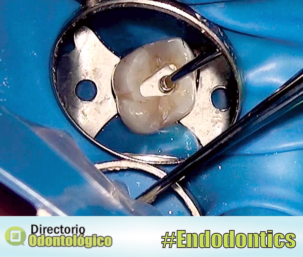 PULPOTOMY in an Adult Tooth Directorio Odontológico