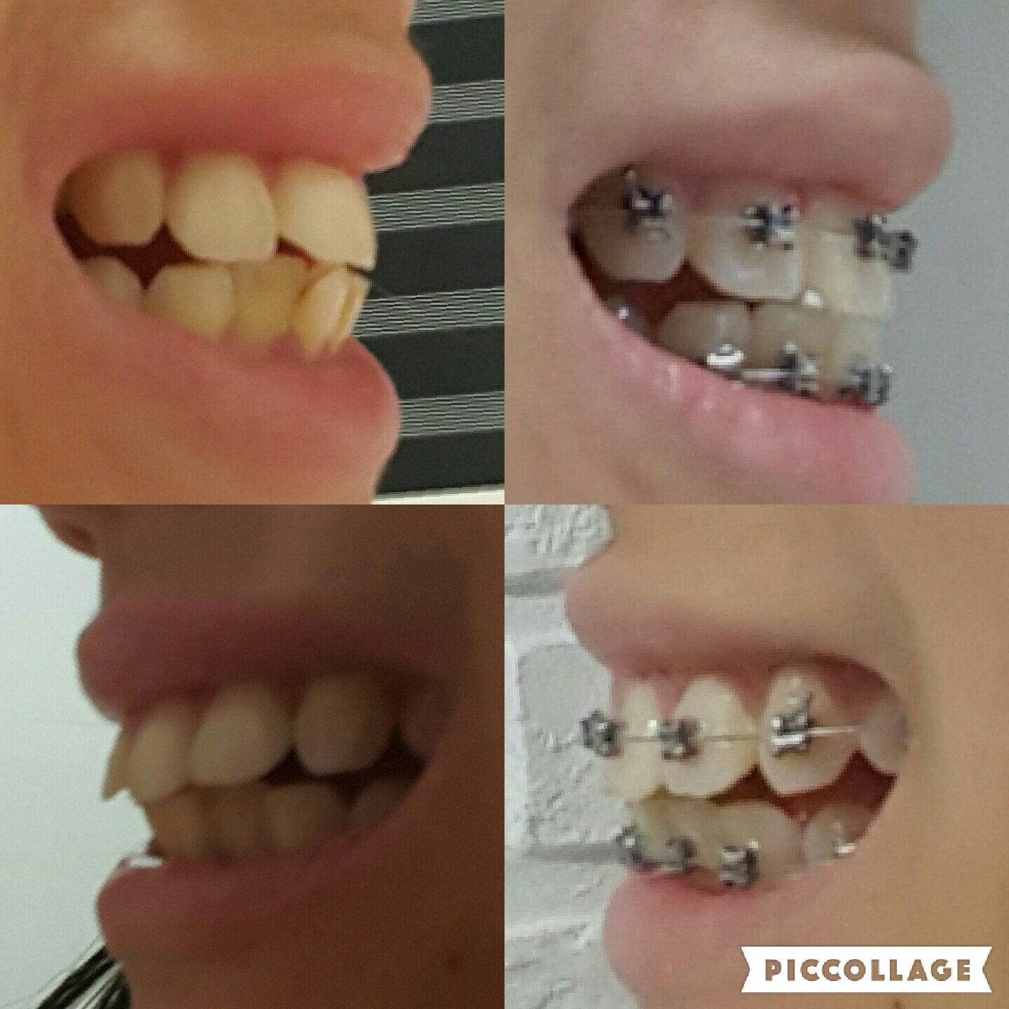 MyStoriesMyLife Self aligning/ligating braces journey