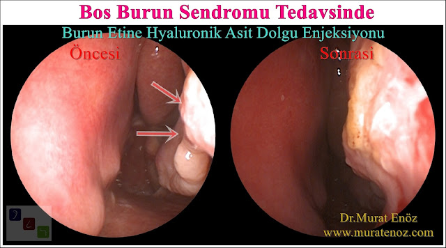 Boş burun sendromu tanımı - Boş burun sendromu belirtileri - Boş burun sendromu tedavisi - Boş burun sendromu tedavisinde Hyaluronik Asit dolgusu - Burun eti dolgusu - Treatment of Empty nose syndrome with hyaluronic acid filler - Boş burun - Geniş burun boşluğu sendromu - Burun eti büyütülmesi - Empty Nose Syndrome (ENS)